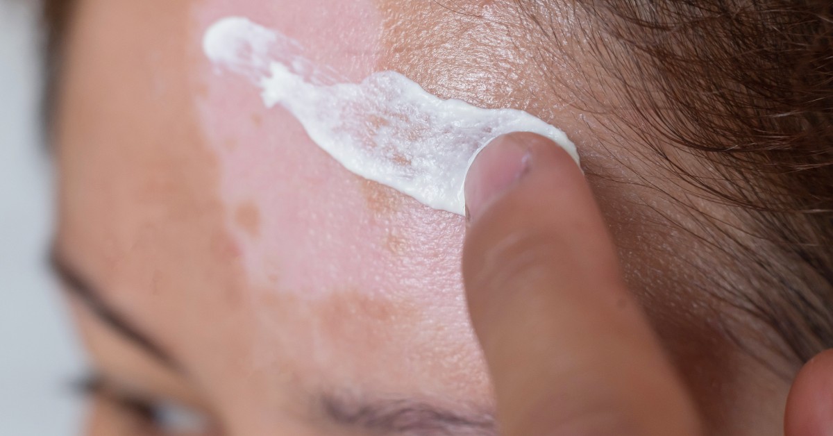 que es el vitiligo 1