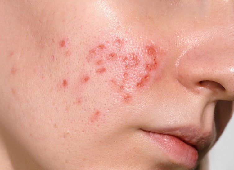 7-barreracutanea--mifarma-blog-body-1