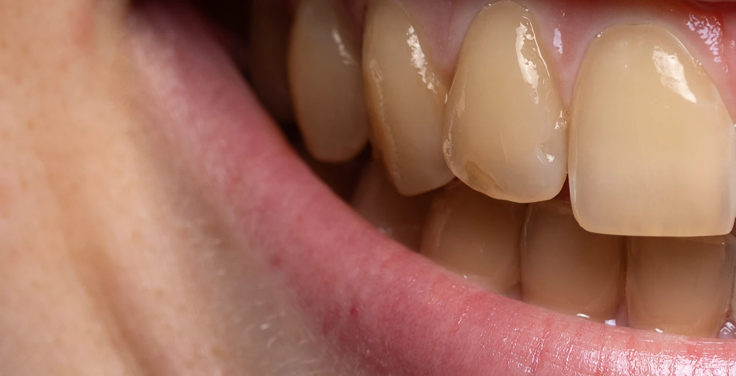 What are Brown Spots on Teeth? 