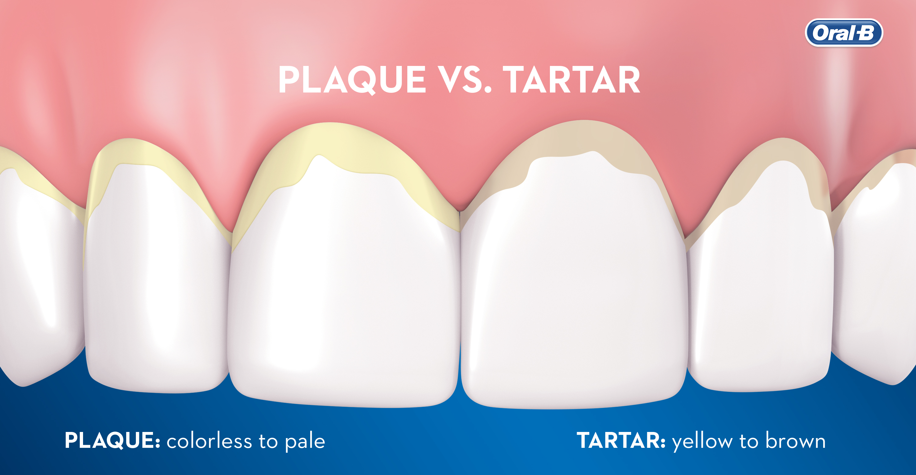 Plaque buildup online