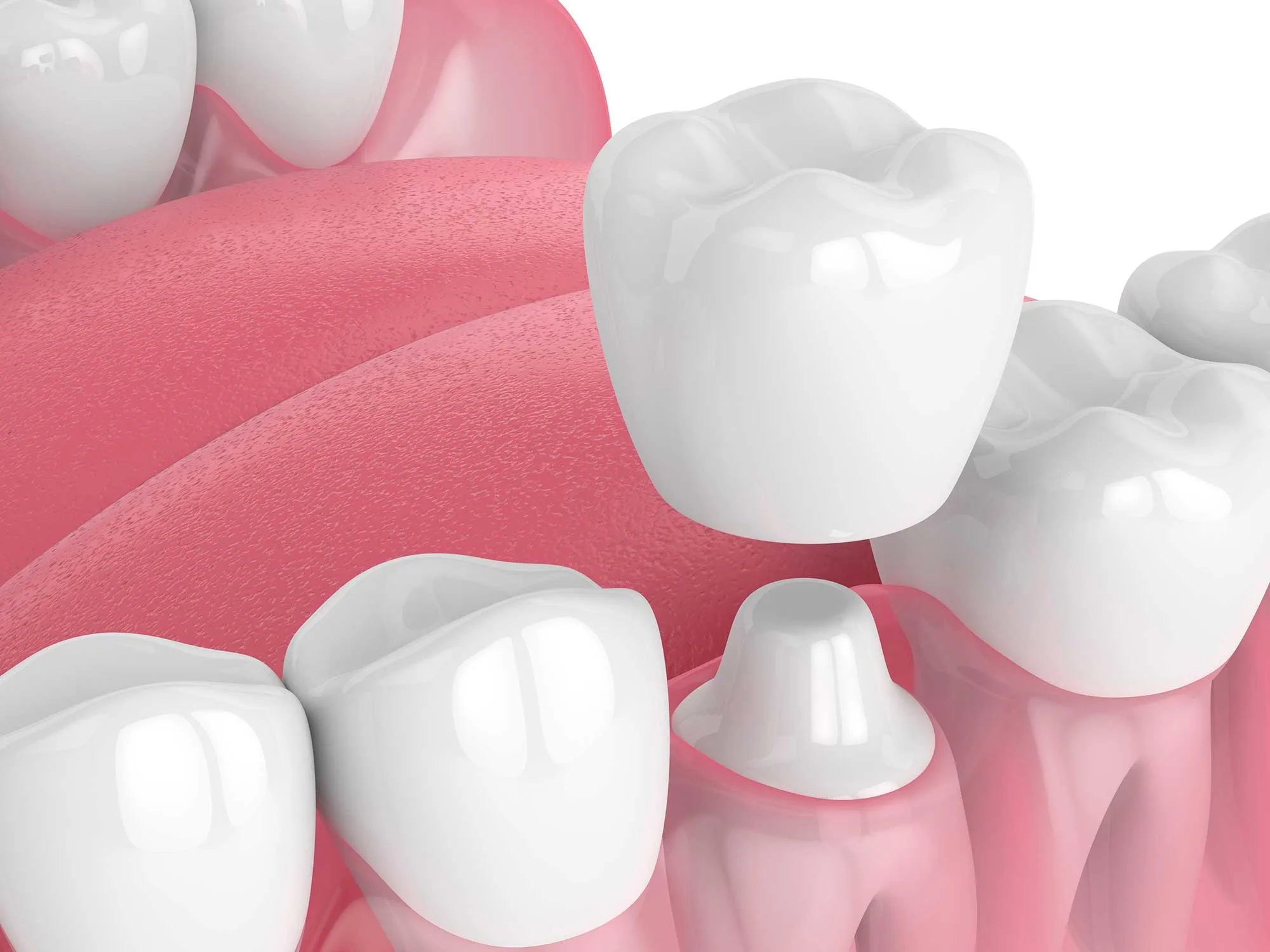 Article - Tooth Cap Vs Crown: What's The Difference - HERO