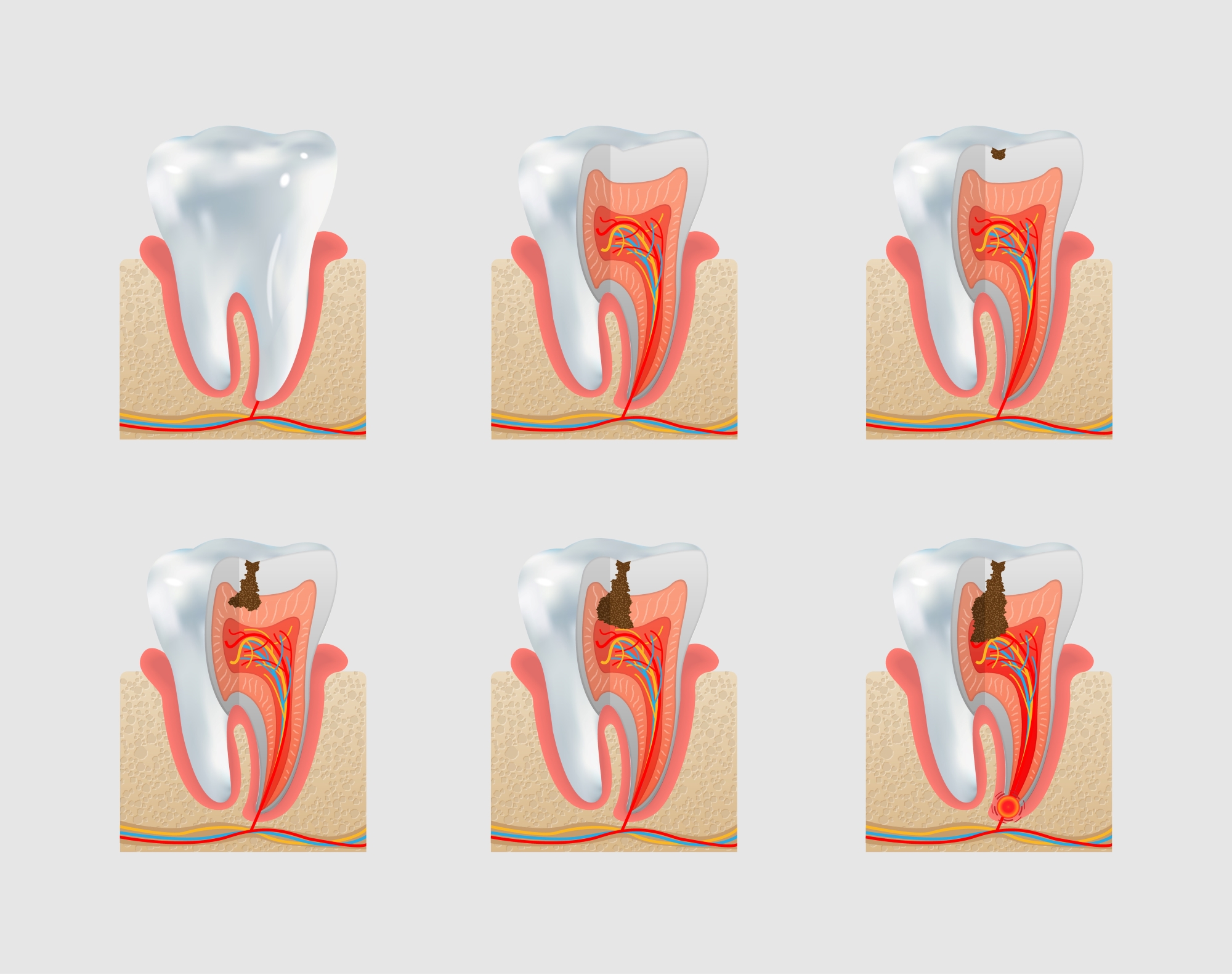 Cavities (Tooth Decay): Causes, Symptoms, and Treatments 
