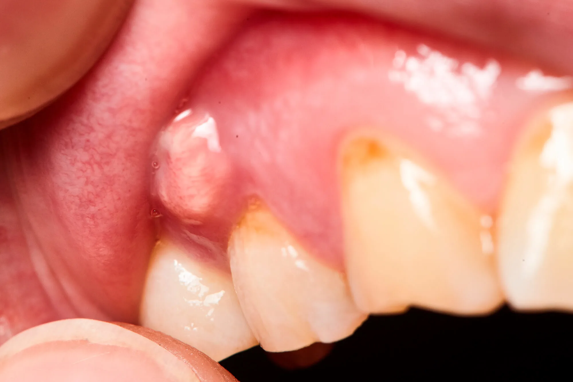 Image - Article - What is a Dental Fistula? Causes, Symptoms and Treatment