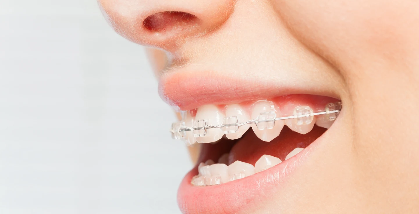 Signs Your Braces are Coming Off Soon 