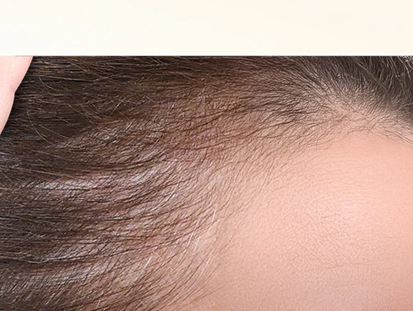 Couro cabeludo com Biotinamina B3. Em 8 semanas, observou-se um aumento real na densidade capilar