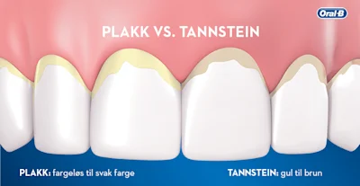 Forskjellen Mellom Plakk Og Tan