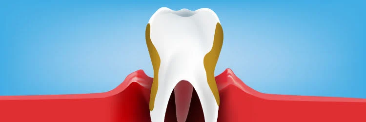 Periodontitt: Symptomer, årsak og behandling