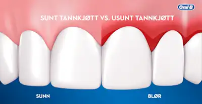 Hva er årsaken til tannkjøttsykdom?