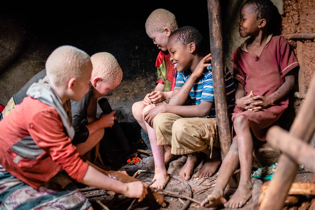 What is Albinism? Five Things You Should Know