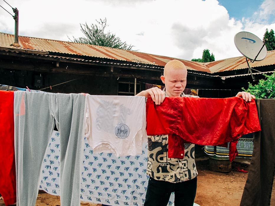 What is Albinism? Five Things You Should Know