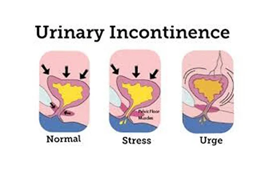 Types of urinary incontinence during menopause