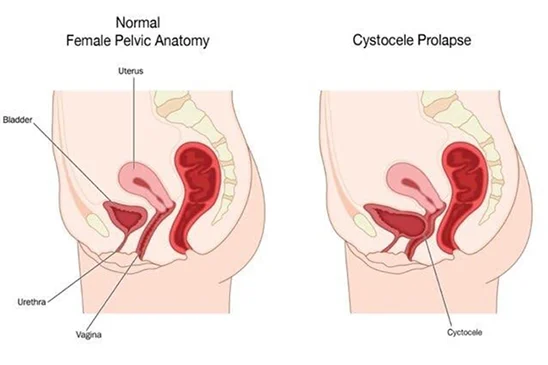 Illustration of prolapsed bladder or fallen bladder