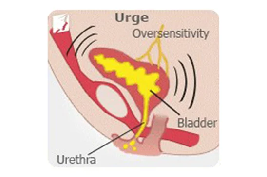 Illustration of urge incontinence