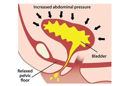 Illustration of stress incontinence