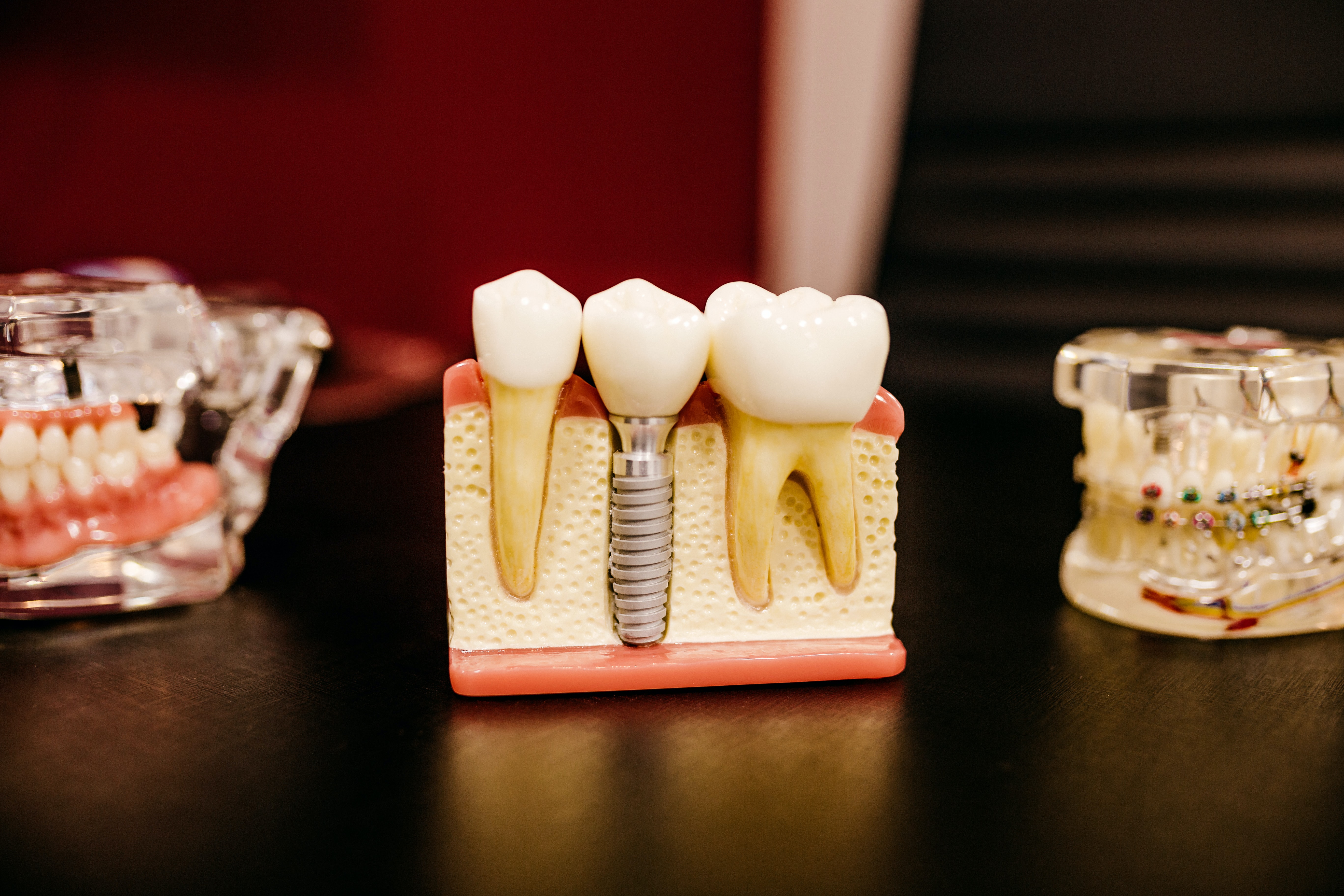 How much does a dental implant cost in Antalya, Turkey?