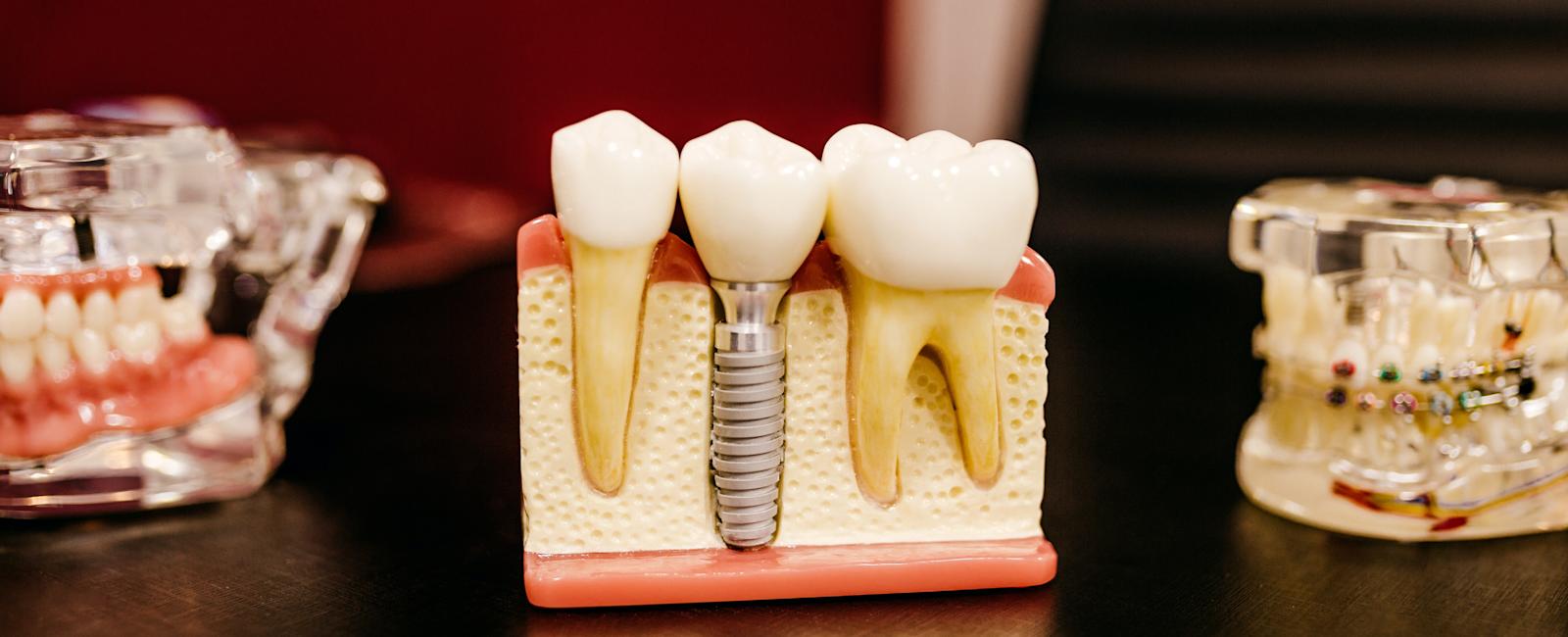 How much does a dental implant cost in Antalya, Turkey?