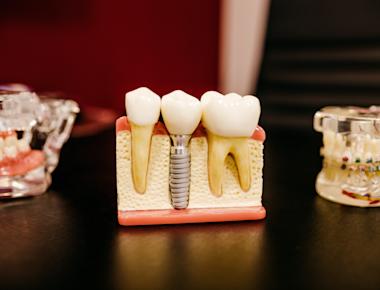 How much does a dental implant cost in Antalya, Turkey?