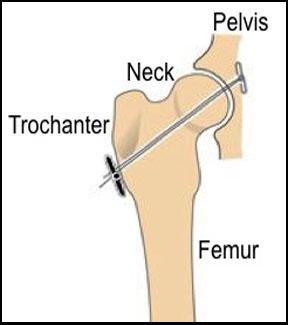 Diagram showing toggle pin repair technique used to stabilize a luxated hip joint in dogs. This method mimics the ligament of the head of the femur for joint support.