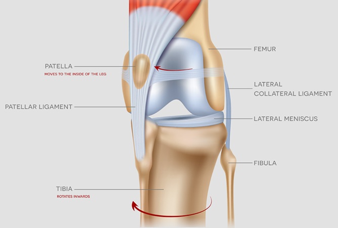 Anatomical illustration showing medial displacement of the patella and inward tibial rotation—key features of medial patellar luxation in dogs.