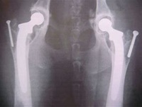 X-ray image showing total hip replacements in both hips of a dog, used to treat severe hip dysplasia and restore joint function.