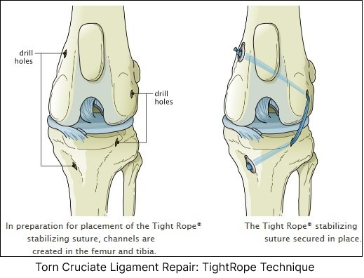 Photo showing the TightRope technique for repairing a torn ACL ligament in dogs. Learn about this advanced procedure at Canton Animal Hospital.