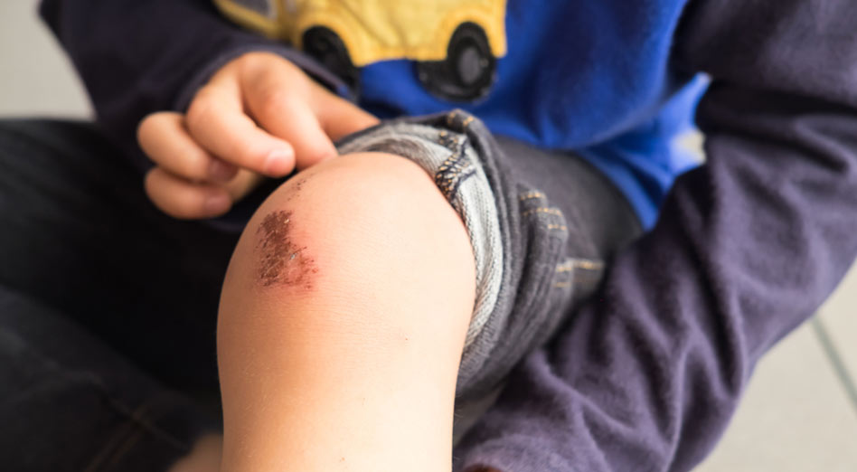 Young kid with a scraped knee sitting on the floor.