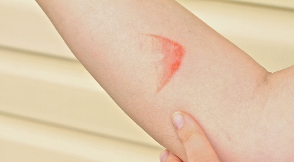 Closeup of steam burn on a person’s forearm