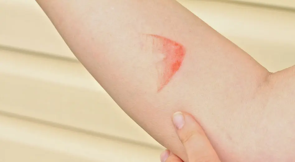 Closeup of steam burn on a person’s forearm