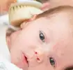 Baby With Cradle Cap