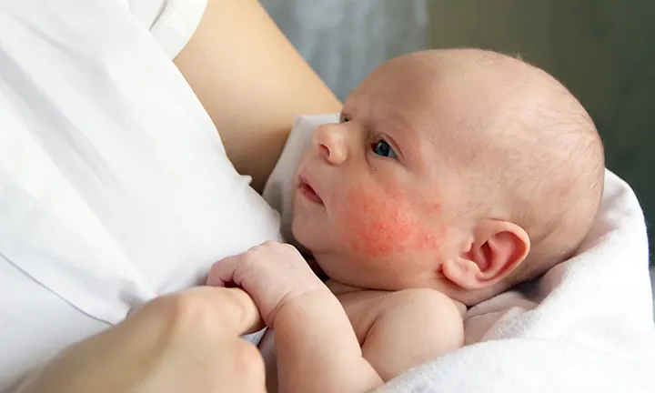 Baby suffering from eczema