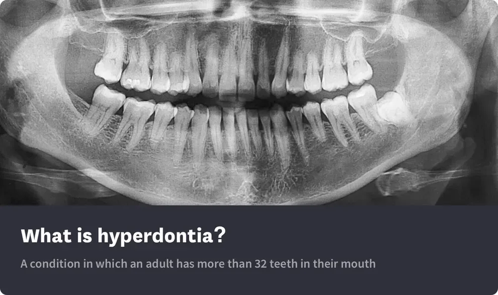 What Is Hyperdontia