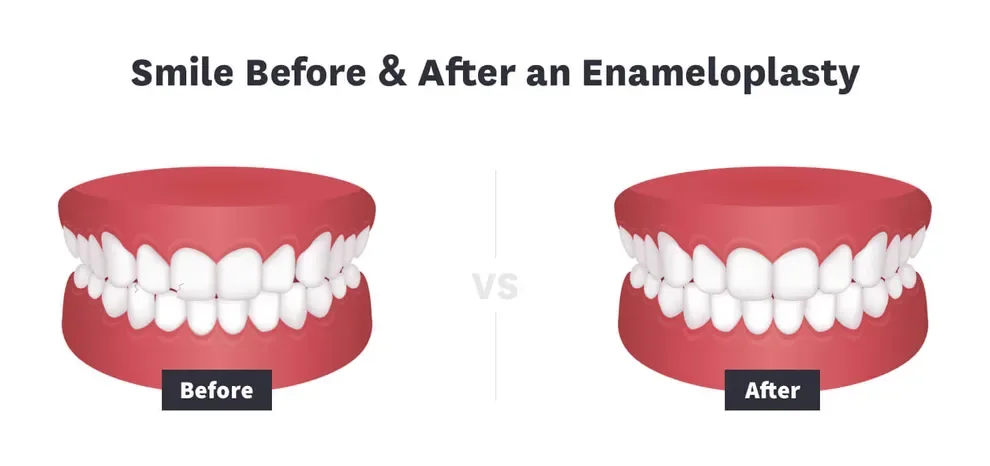 smile before and after an enameloplasty