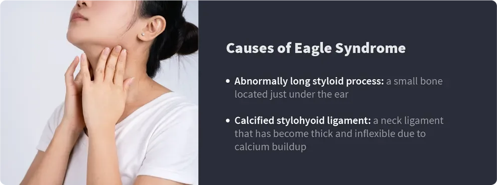 causes of eagle syndrome