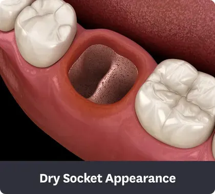 Dry Socket Appearance