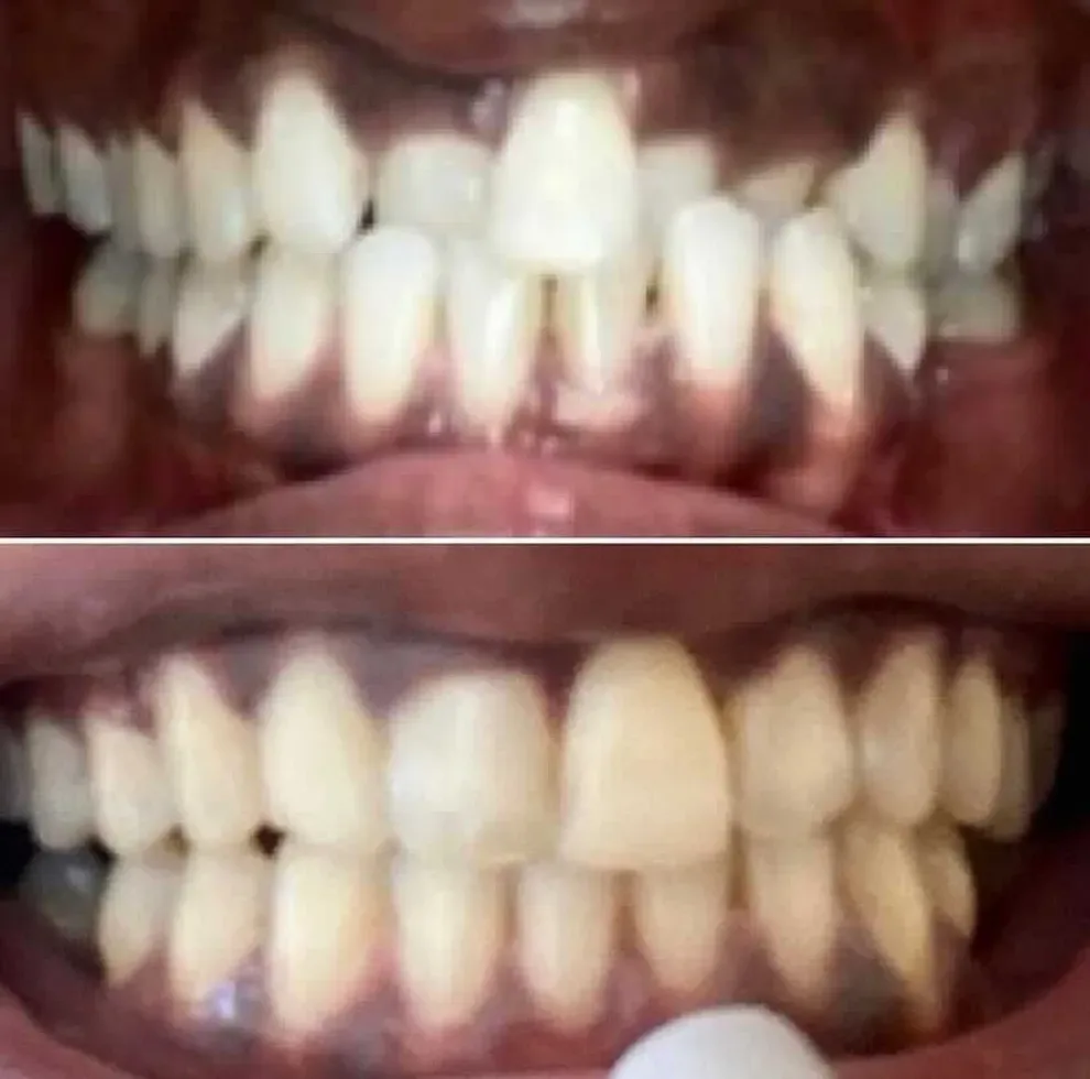 crossbite before and after