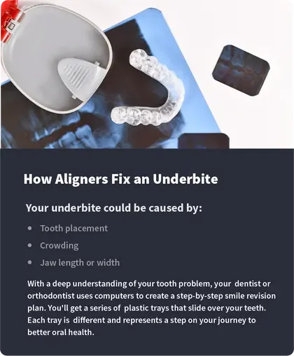 How Aligners Fix an Underbite