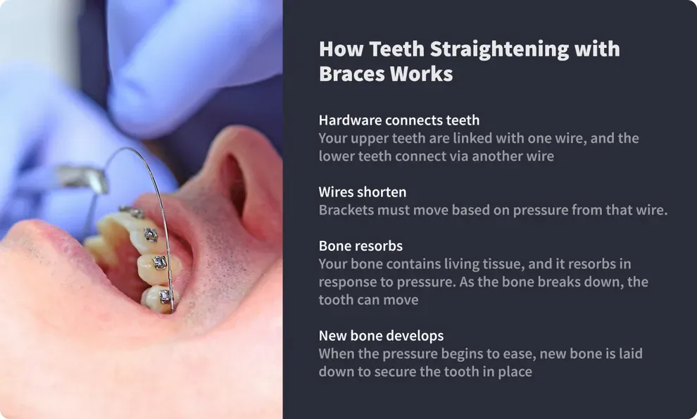 how teeth straightening with braces works