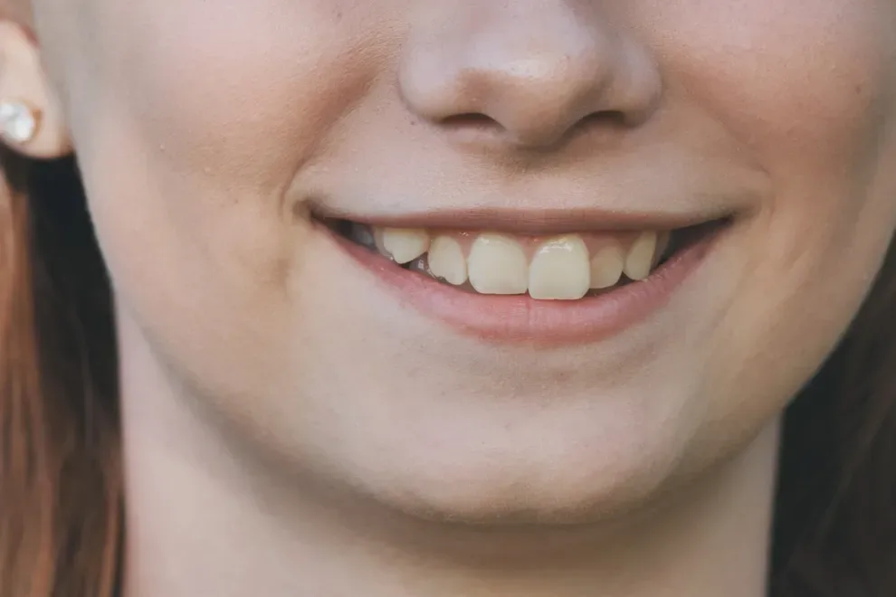 crooked-top-teeth