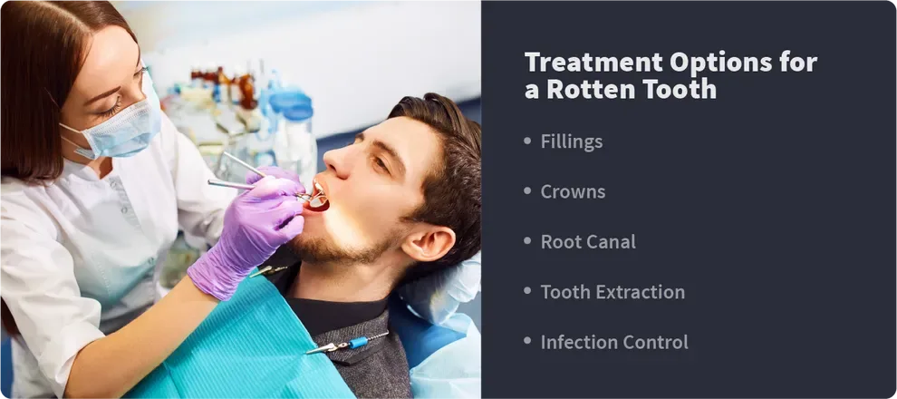 treatment options for a rotten tooth