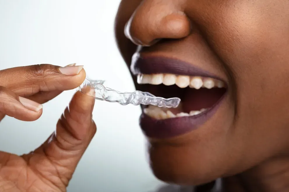 Invisible Braces and Aligners: Types & Comparisons, Byte®
