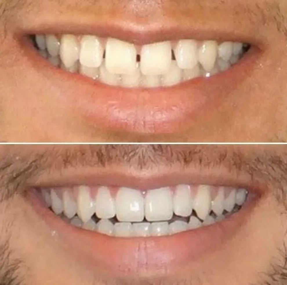 The Best Way to Treat an Overbite - Lakefront Family Dentistry