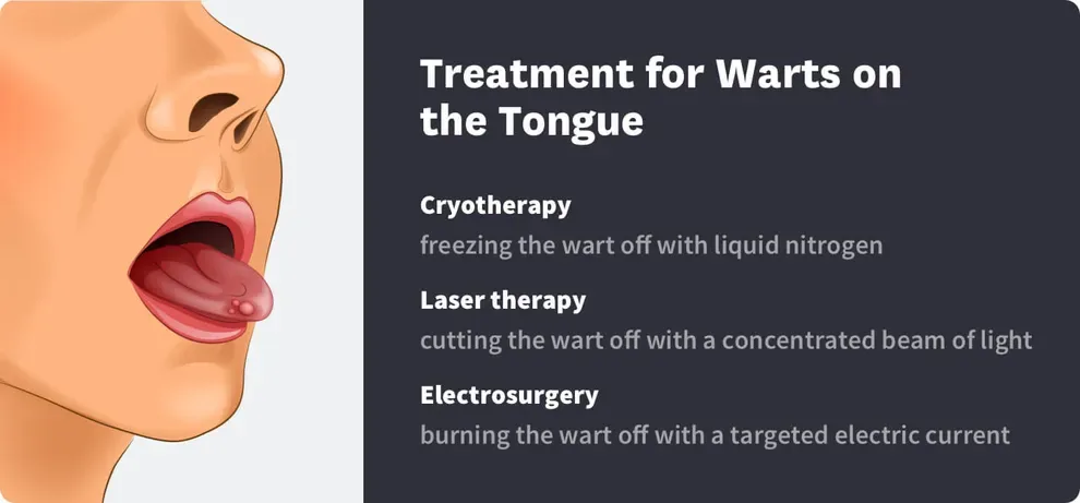 Treatment for Warts on the Tongue