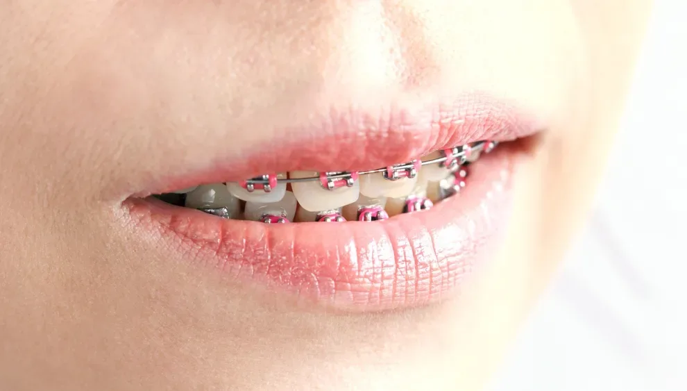 Do Braces Hurt When Put On, Tightened, or Taken Off? Byte®