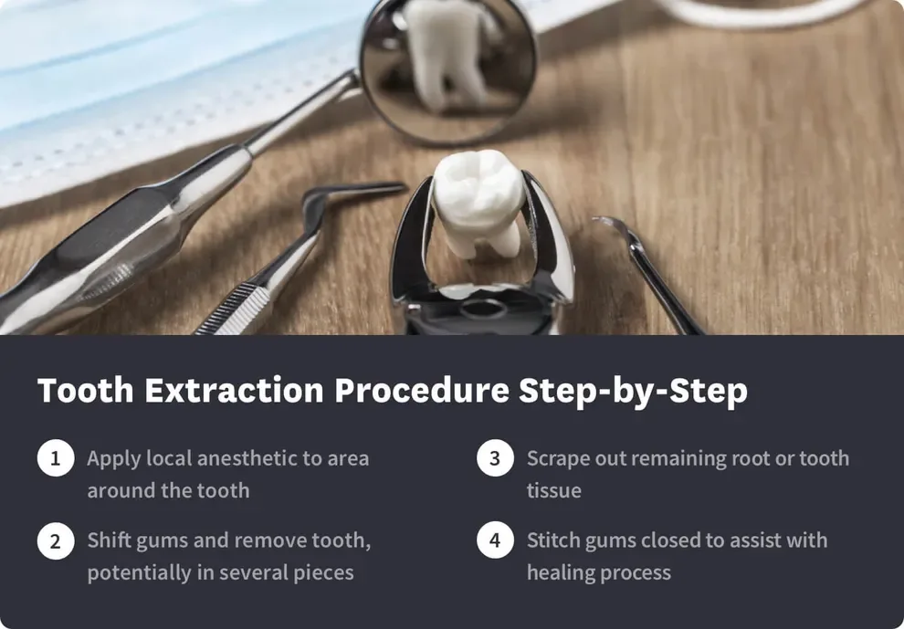 Tooth Extraction Procedure Step by Step