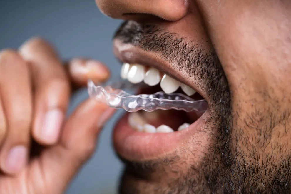 Can You Smoke With Invisalign Byte Byte