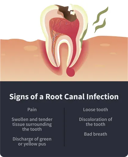 signs of a root canal infection