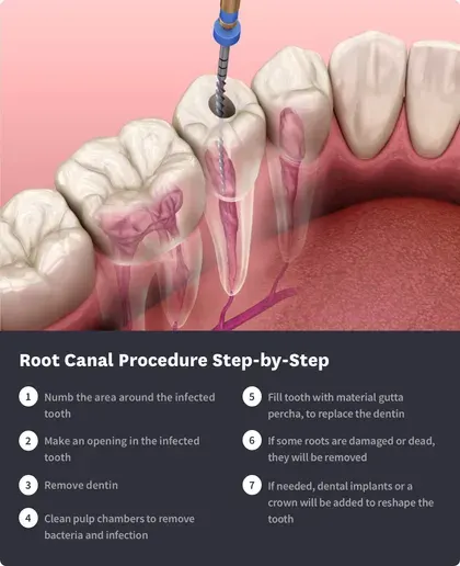 root canal procedure step-by-step