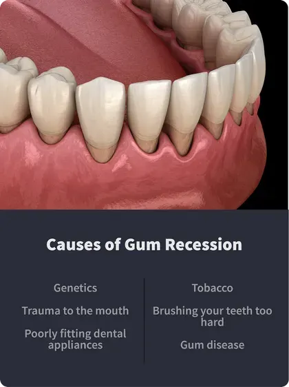 Causes of Gum Recession