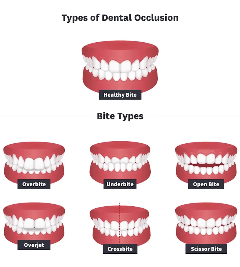 What Is Dental Occlusion and How to Safely Treat It Byte® Byte®