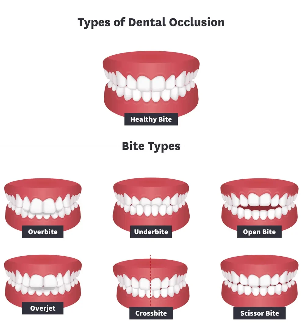 Types of Dental Occlusion